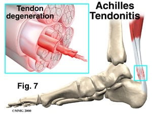 Common Conditions - Achilles Tendonitis