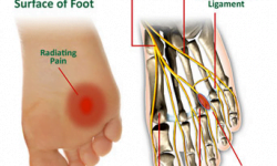 Common Conditions - Mortons Neuroma