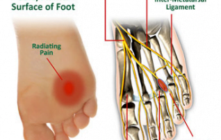 Common Conditions - Mortons Neuroma