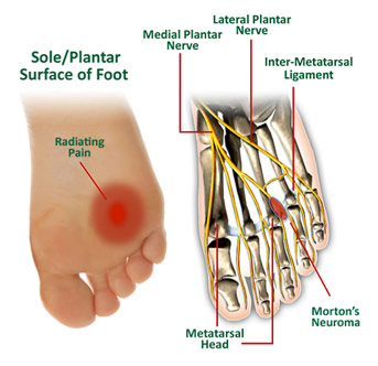 Common Conditions - Mortons Neuroma