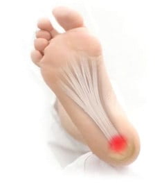 Common Conditions - Plantar Fasciitis