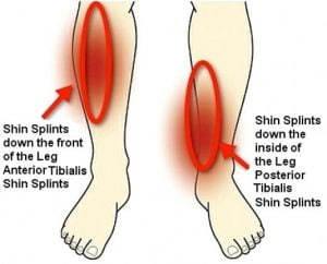 Common Conditions - Shin Splints