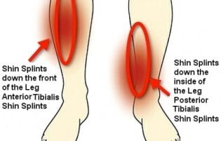 Common Conditions - Shin Splints