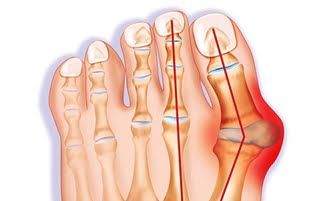 Bunions